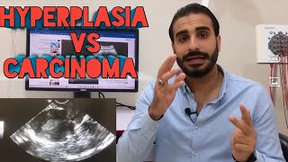 LEVEL 3  FEMALE PELVIS  GYN  Endometrial lesion Hyperplasia vs Carcinoma [upl. by Ahsenad]