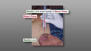 Fine Needle Aspiration Biopsy FNA Techniques  Ultrasound Guided FNA The Parallel Approach [upl. by Ahsinnor519]