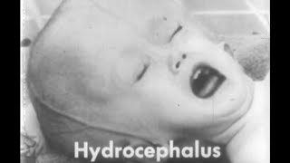 Hydrocephalus waterbrain 1950s Medical Teaching film on the quotFeeblemindedquot [upl. by Eatnad]