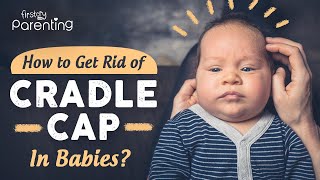 Cradle Cap in Babies  Causes and Remedies [upl. by Notaes]