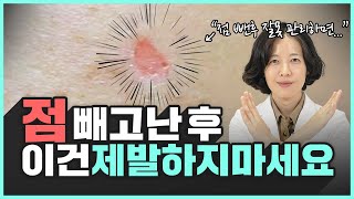 의사가 알려주는 점빼고 흉터 색소침착 남지 않는 후관리 방법  흉터 색소침착 [upl. by Eetse]