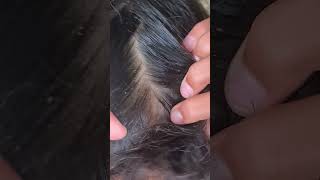 Nitpicking satisfying licecomb hair louse headliceremoval [upl. by Letti840]