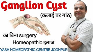 Ganglion cyst कलाई पर गाँठ  Best Homeopathic treatment without surgery [upl. by Dirfliw]