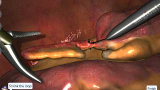 LapSim Appendectomy Loop Technique [upl. by Briney]