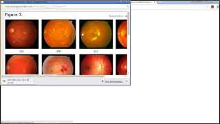 Optic Disc Localization Retinal Image Processing  MATLAB Code Implementation [upl. by Enylekcaj127]