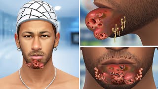 ASMR Removes Worms Pustules Maggots on Chin amp Blackheads  Deep Cleaning Animation [upl. by Tamqrah]