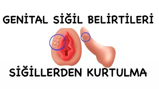 Genital Siğilden Nasıl Kurtulabilirim Siğil Belirtileri Siğil Kremi Lazer Dondurma Yakma Tedavisi [upl. by Adnama]