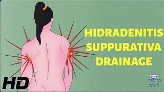 Hidradenitis Suppurativa Drainage How to Minimize Pain and Discomfort [upl. by Ellerrad]