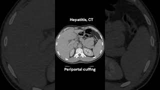 Hepatitis CT imaging radiology liver infection emergency [upl. by Maurreen]