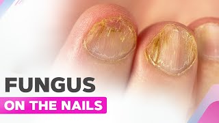 Fungus on the Nails  Koilonychia  Manicure and Fungus Cleanup [upl. by Eerdua]