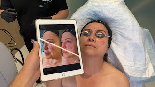 SEE HOW VASCULAR LASER CAN LIGHTEN A 20 YEAR OLD FACIAL PORT WINE STAIN BIRTHMARK  DR JASON EMER [upl. by Gabbie607]