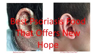 EnerFlex Nutrition  Case Studies on Scalp Plaque and Erythrodermic Psoriasis Updated 42016 [upl. by Sashenka]