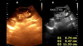 Hydro nephrosis  Renal cortical cyst  Renal calculus [upl. by Wolfram301]