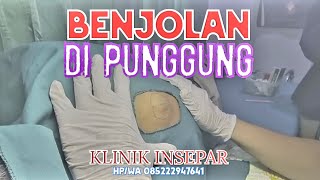 MENGANGKAT BENJOLAN DI PUNGGUNG EKSTIRVASI LIPOMA  syarhan ruralhealthcare [upl. by Erdied347]