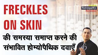 Freckles on face  Natural homeopathic remedies with symptoms  होम्योपैथिक उपचार [upl. by Peednama]