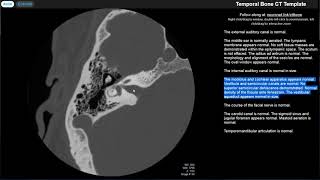 Radiology Walkthroughs  CT Temporal Bone Anatomy [upl. by Atyekram]