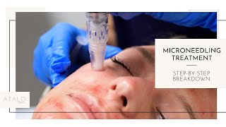 Microneedling I Facial Rejuvenation I StepByStep [upl. by Belvia973]