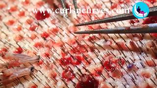 Best FUE Hair Transplant in Bangalore Hair Restoration Surgery Bangalore [upl. by Ecyrb]