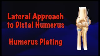 Lateral Approach to Distal Humerus Humerus Plating Surgical Technique  Dr Deepak Garg [upl. by Ridinger]