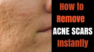 Instant acne scar removal [upl. by Notaek]