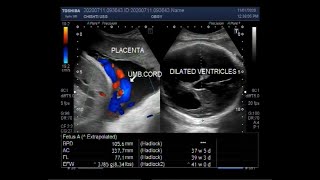 Ultrasound Video showing Cephalopelvic disproportion due to Hydrocephalus [upl. by Eba]