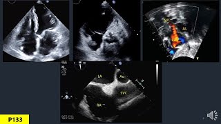 Anatomy Of Heart In Echo Part 6 Right Atrium [upl. by Dyob]