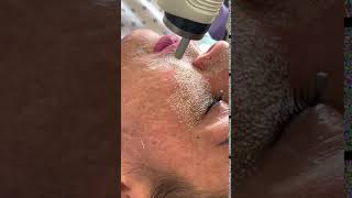 Fractional CO2 Laser Resurfacing [upl. by Aihsyn]