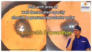 Posterior subcapsular or presumed posterior polar cataract  Thinking process Dr Sourabh Patwardhan [upl. by Nivla]