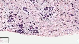 Tubulolobular Carcinoma Breast  Histopathology [upl. by Jobie]