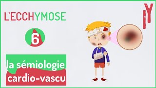 EPISODE6 sémiologie cardiovasculaire LECCHYMOSE [upl. by Nuajed]