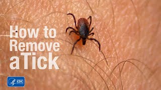 How to remove a tick [upl. by Malim]