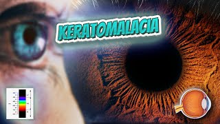 Keratomalacia Your EYEBALLS 👁️👁️💉😳💊🔊💯✅ [upl. by Levon]