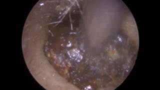 The Oily Ear  Ear Wax Removal by Mr Neel Raithatha The Hear Clinic [upl. by Wager]