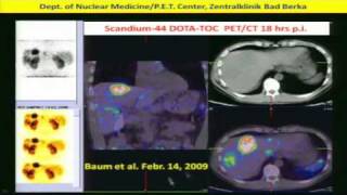 Neuroendocrine Tumors Diagnosis amp Treatment w Peptide Receptor RadiotherapyPRRT Dr Baum 2of2 [upl. by Oneida120]