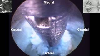 Percutaneous Endoscopic Interlaminar Lumbar Discectomy PEILD by Dr Hyeun Sung Kim01 [upl. by Hite]