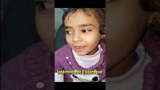 Intermittent Exotropia [upl. by Nevetse]