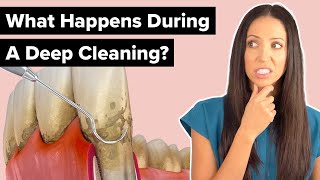 What Happens During a Deep Cleaning Procedure Scaling and Root Planing [upl. by Sesilu]