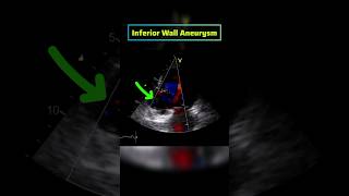 Aneurysm of inferior Wall of Heart ♥ on Echocardiography echo [upl. by Avirt]