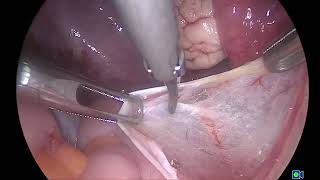 Lap excision of incidentally found deep endometriosis in a patient with mucinous ovarian cyst [upl. by Burner343]