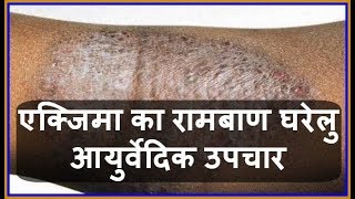 Health Tips एक्जिमा का रामबाण घरेलु आयुर्वेदिक उपचार  Charm Rog  Eczema ka Gharelu Upchar [upl. by Llemhar]