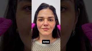 RESULTADO DE BOTOX  BIORECONEXÃO rejuvenescimentofacial hof esteticaregenerativa botox [upl. by Dihsar]