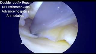 double rootfix repair of Meniscus Root tear type 2 C laprade [upl. by Amliv966]