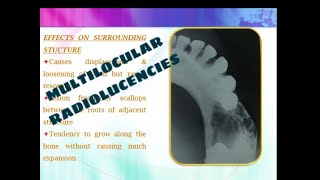 MULTILOCULAR RADIOLUCENCIES OF THE JAW [upl. by Hector]