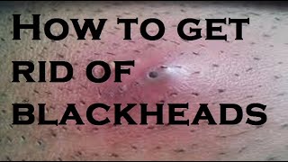 Blackhead Removal Tips [upl. by Charie]