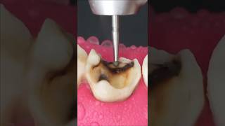 Root Canal Treatment proceduresubscribeytshorts [upl. by Katushka]