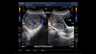 Ultrasound Video showing Hydatidiform Mole also called Molar Pregnancy [upl. by Eirrem]