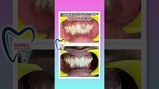 Accident Traumatic Tooth Treatment dentist dentalsmiledesigning dentalbridge [upl. by Surad659]