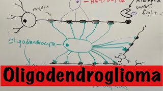 Oligodendroglioma [upl. by Sudbury]