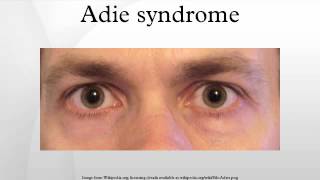 Adie syndrome [upl. by Coco842]