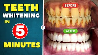 Teeth Whitening at Home 100 effective  Teeth whitening products  Professional teeth whitening [upl. by Gyatt581]